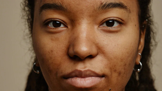 Taches pigmentaires : pourquoi apparaissent-elles et comment les traiter durablement ?